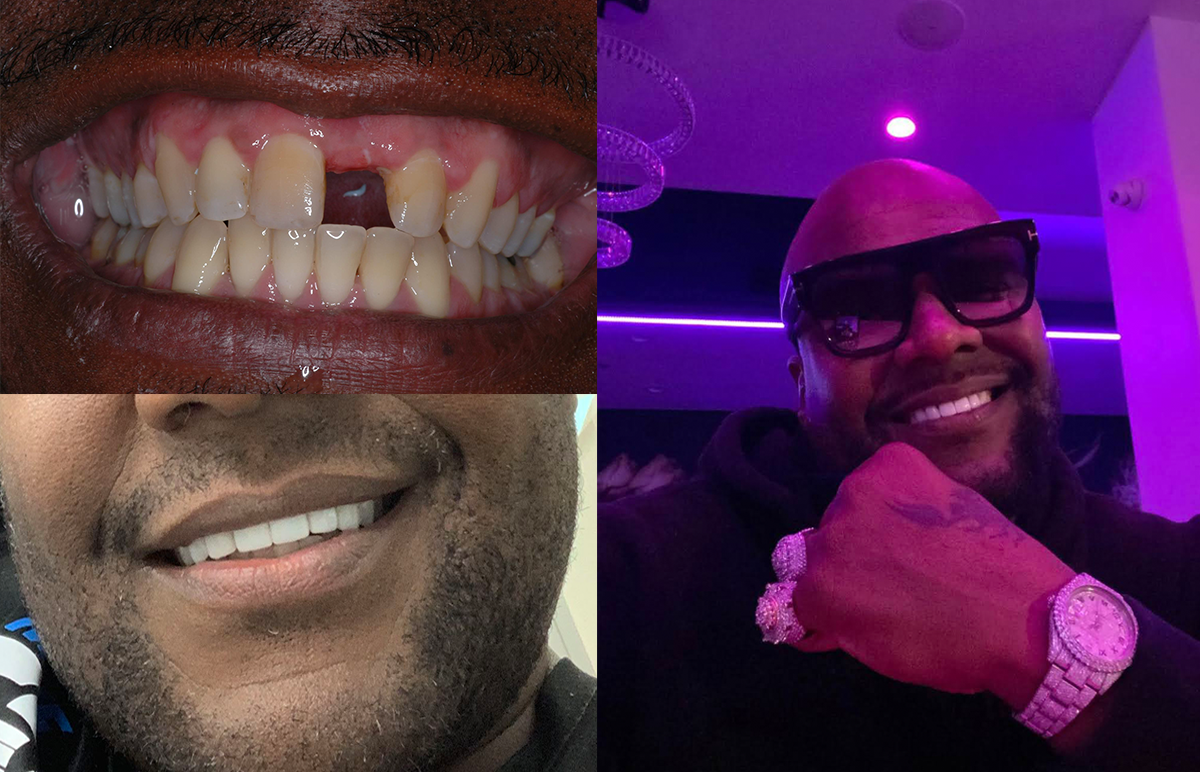 Complete Smile Transformation Before & After