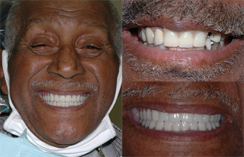 Implant Supported Dentures before and after